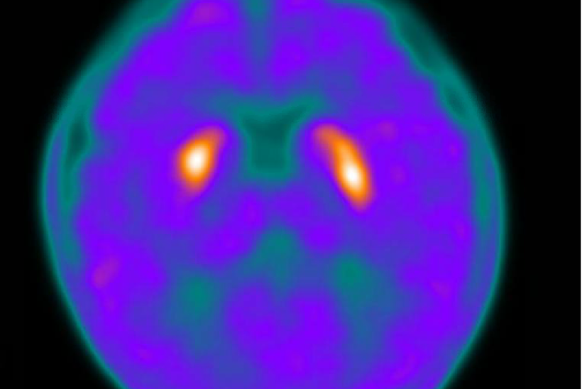 صورة الأشعة الدماغية التي أجريت لغونريت عقب خضوعها للجراحة يظهر فيها الدماغ باللون البنفسجي على خلفية سوداء