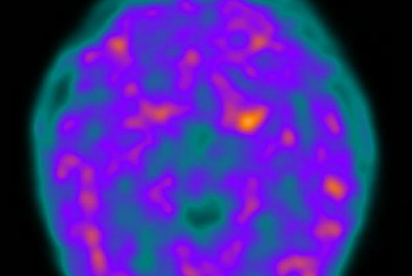 صورة الأشعة الدماغية التي أجريت لغونريت قبل خضوعها للجراحة يظهر فيها الدماغ باللون البنفسجي على خلفية سوداء