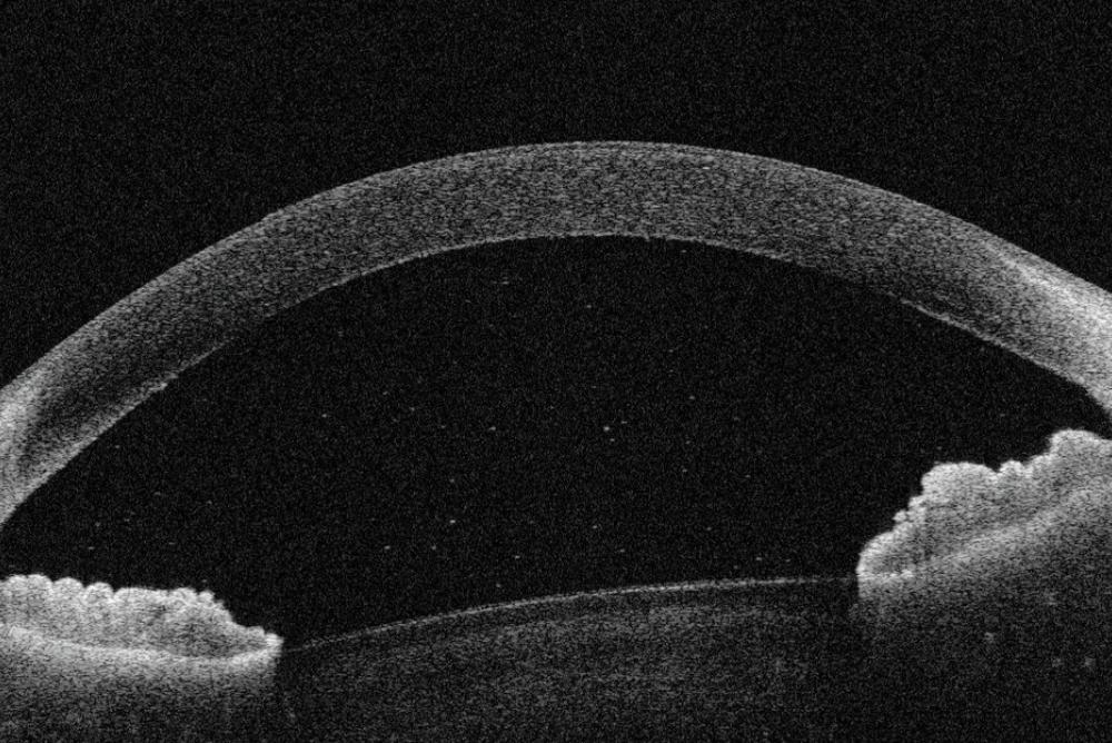 This scan image is taken from a separate Uveitis research project 'Eye on Eyes' led by Dr Lola Solebo, Consultant Paediatric Ophthalmologist, GOSH